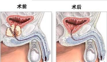 前列腺增生需要做哪些检查？(图9)