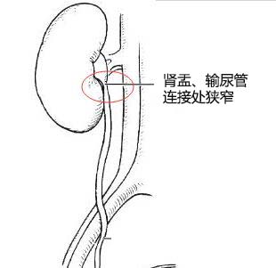 肾积水是怎么形成的？(图2)