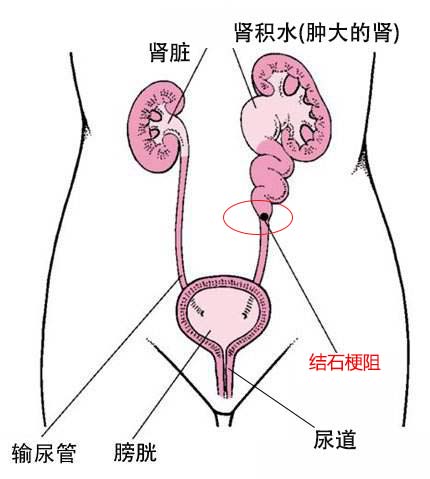 一分钟认识解肾结石(图2)