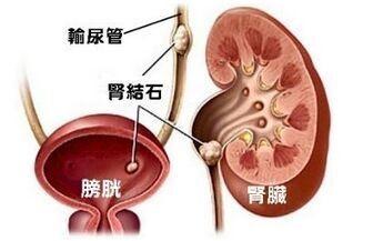 膀胱结石(图1)
