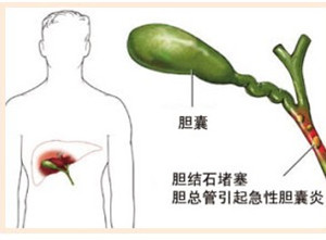 专家解析胆囊炎形成的原因(图1)