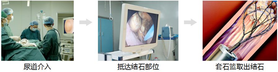 推荐：治疗输尿管结石的好方法(图2)