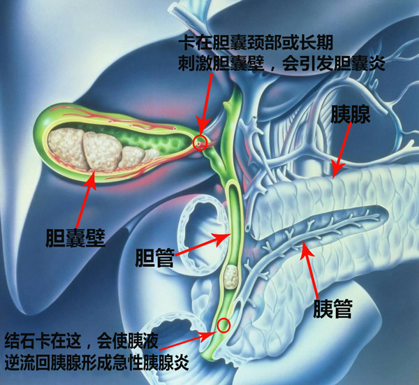 看了文章在决定，胆结石要不要手术！(图1)