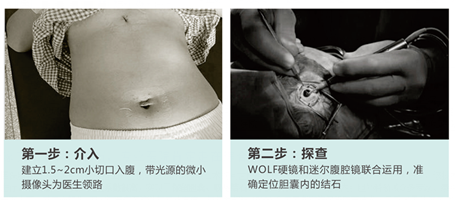 论胆结石的治疗方法是什么？(图3)