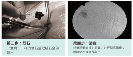 论胆结石的治疗方法是什么？(图4)