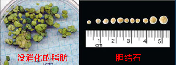 “胆结石排石法？”——都是假的！(图2)