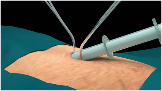 经脐隐瘢痕保胆取石术 保留胆囊、取净结石、不伤身体(图1)