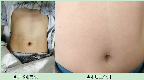 经脐隐瘢痕保胆取石术 保留胆囊、取净结石、不伤身体(图2)