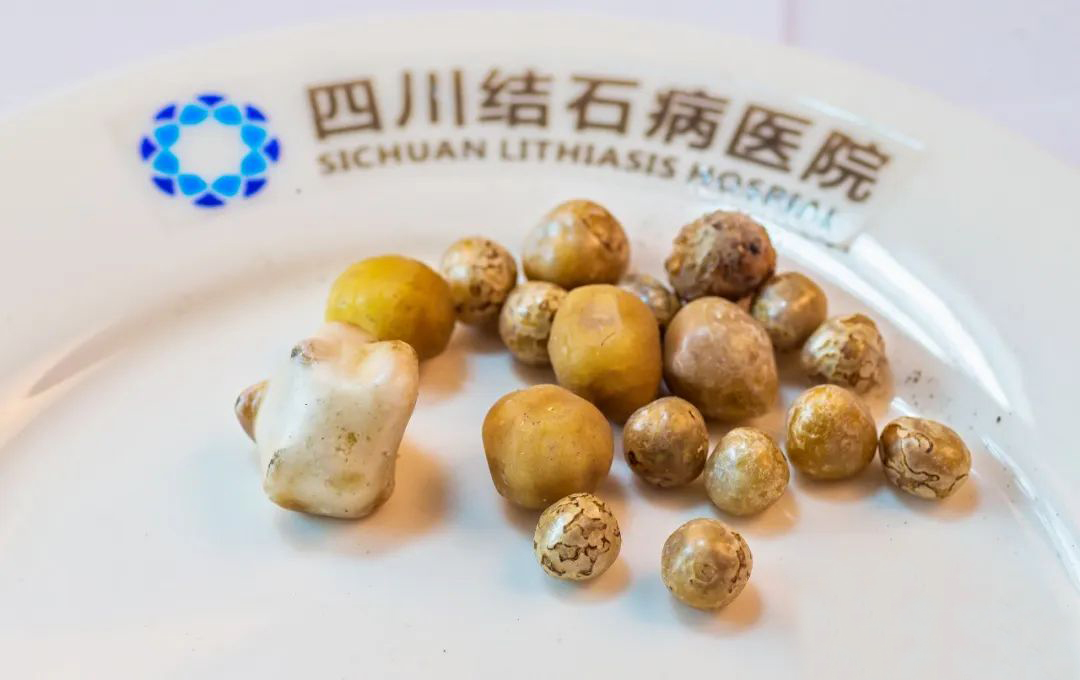 成都保胆取石医院科普：不想切胆，6、70岁的胆结石患者就只能熬吗？？(图4)