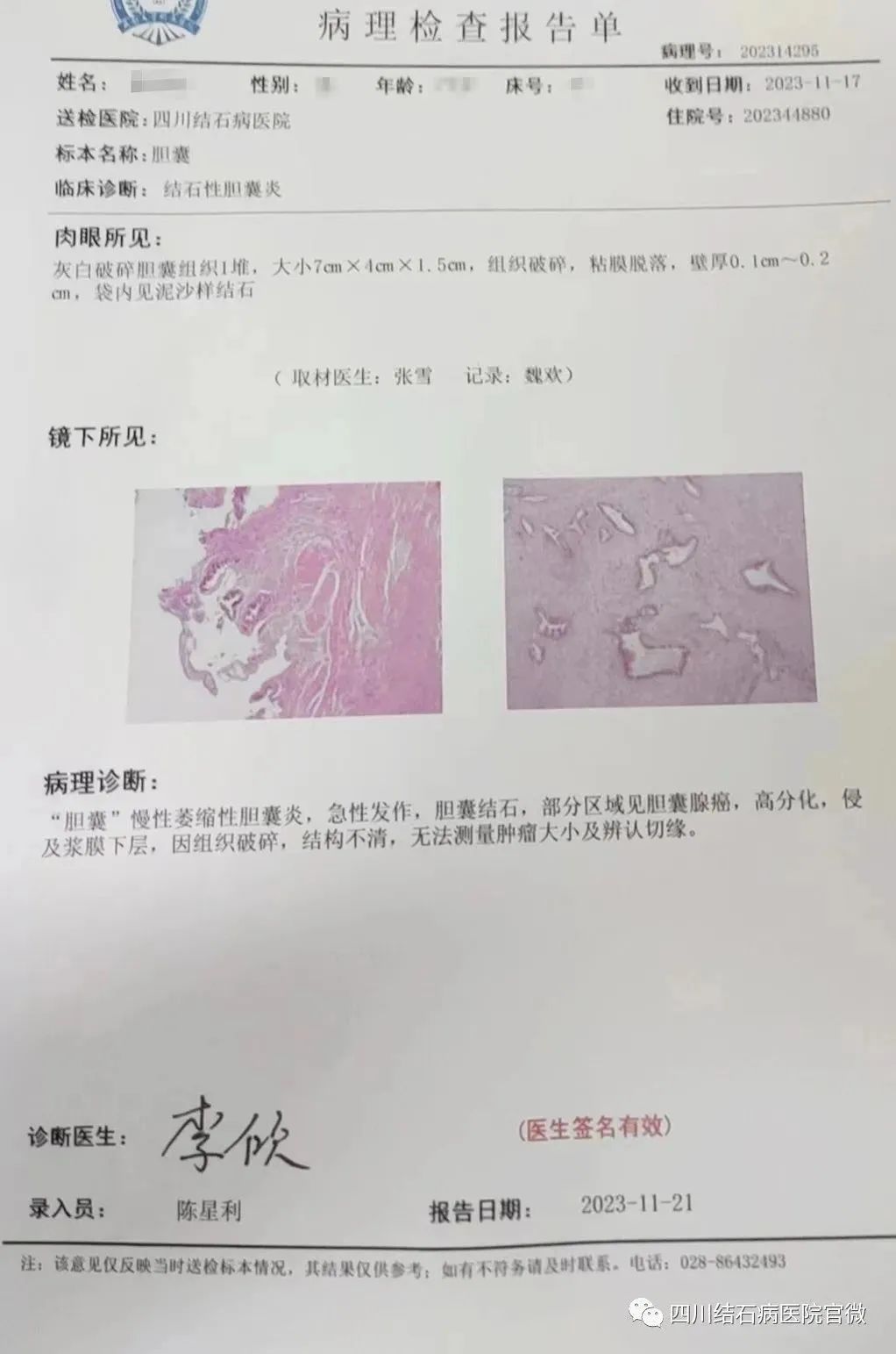 胆结石拖一拖无所谓？四川胆结石专家：那是你没见识到它的“杀伤力”(图1)