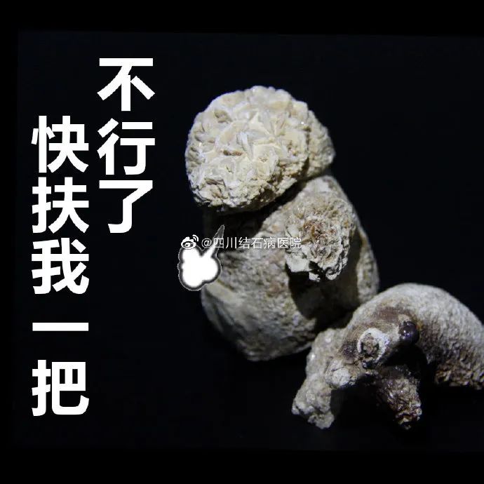 胆结石拖一拖无所谓？四川胆结石专家：那是你没见识到它的“杀伤力”(图3)