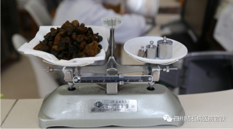 胆结石拖一拖无所谓？四川胆结石专家：那是你没见识到它的“杀伤力”(图4)