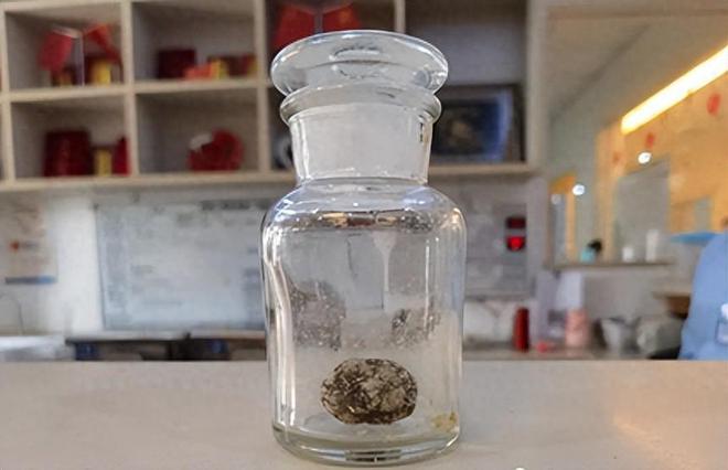 成都保胆取石哪家医院好？成都金堂患者不仅成功保胆，还没留疤痕(图1)