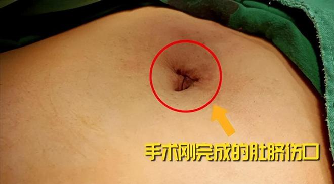 成都保胆取石哪家医院好？成都金堂患者不仅成功保胆，还没留疤痕(图2)